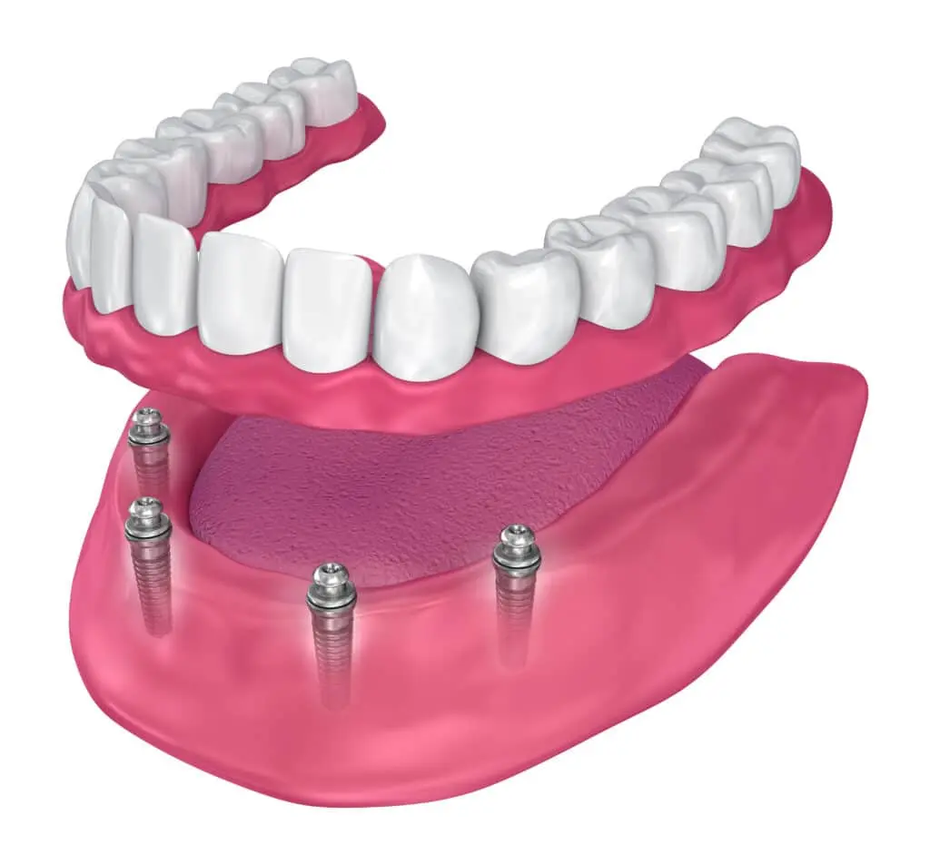 Diagram of All-on-X dental implants angled in the jaw