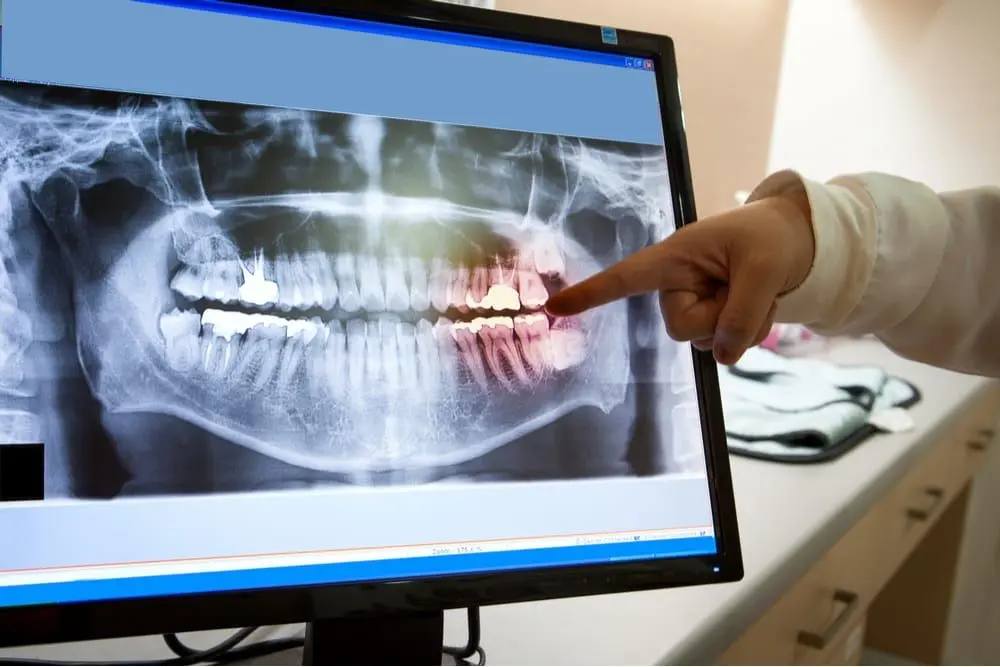 Digital X-Rays
